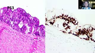 Tip82 Highgrade Appendiceal Mucinous Neoplasm [upl. by Serg]