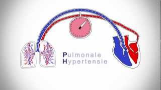 Pulmonale Hypertensie wat is dat [upl. by Warner]