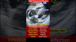 Mild Pericardial Effusion Echo and Treatment l PE echo effusion shorts [upl. by Gildea598]