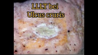 Ulcus Cruris Behandlung mit LLLT  HELBO Minilaser 3120 Anleitung Ulcus mit Laser behandeln [upl. by Jeddy191]