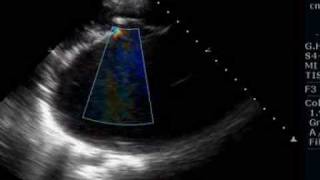 Giant left atrium due to rheumatic mitral stenosis and regurgitation [upl. by Gnol]