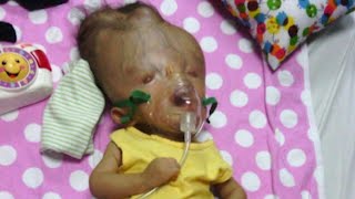 Toddler with Birth Defects Incompatible with Life Defies Odds in Venezuela [upl. by Hatch457]