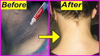 Just 5 minutes Whitening Challenge PermanentlyHow to Get Rid of Dark Neck Fast amp Easy by Toothpaste [upl. by Posehn]