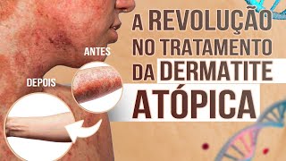 A revolução no tratamento da dermatite atópica [upl. by Jacy]