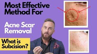 How To Treat DEEP ACNE SCARS  What is SUBCISION [upl. by Jammie]