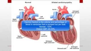 Cardiomyopathy CMP [upl. by Chlori79]