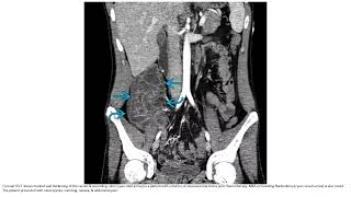 Neutropenic Colitis Imaging [upl. by Kaye]