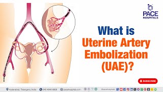 Uterine Artery Embolization UAE  What is Uterine Artery Embolization uterinearteryembolization [upl. by Ursuline832]