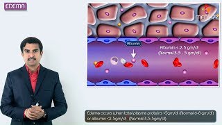 1Edema introduction  Hemodynamic pathology Fmge Neet PG and usmle [upl. by Hurty]