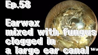 ep58 Severe earwax removal [upl. by Elenahc]