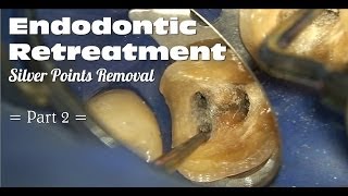 Endodontic Retreatment  Silver Points Removal Part 2 [upl. by Asreht]