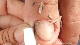 The easiest way to clean the corners of your toenails  part 58NhaNguyenPhanThiet [upl. by Ansev]