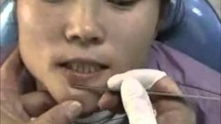 How to scrape the chin for demodex mites [upl. by Broder]