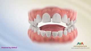 Orthodontic Treatment for Tongue Thrusting Habit  Different Options [upl. by Eciram968]