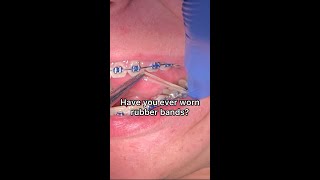 Getting rubber bands for the first time Braces Elastics Tooth Time Family Dentistry New Braunfels [upl. by Naujat672]