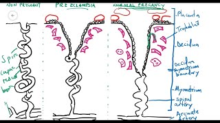 Preeclampsia [upl. by Anol]