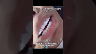 Why You SHOULDN’T Go To A Nail Tech For Veneers 💅🦷 [upl. by Yelhak362]