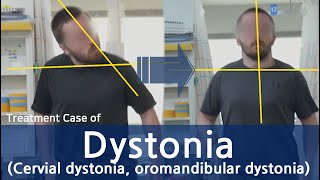 Dystonia  Cervical dystonia  oromandibular dystonia  사경증 치료사례  근긴장이상증 [upl. by Anyotal]