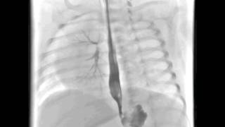 Tracheoesophageal Fistula in a Newborn [upl. by Moria]