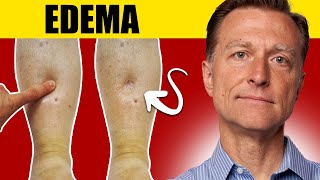 8 Surprising Causes of Edema Uncover the Truth [upl. by Yclehc]