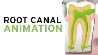 Root Canal Treatment RCT Step by Step Animation [upl. by Selimah365]