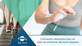 Electroestimulación TENS aplicación  Síndrome del túnel Carpiano  Correcta colocación electrodos [upl. by Ysiad]