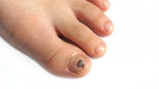 What Does It Mean When Your Toenail Turns Black [upl. by Nylzor]