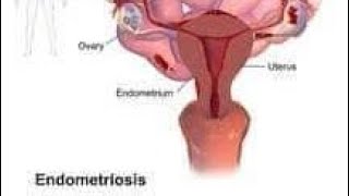 Endometriosis and Fertility Success Story [upl. by Marilou720]