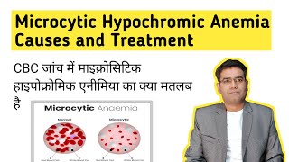 What is Microcytic Hypochromic Anemia its Causes and Treatment in Hindi Iron Deficiency [upl. by Koblas]