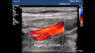 Corsi di ecocolordoppler dei TSA Tronchi Sovra Aortici [upl. by Kreiner]