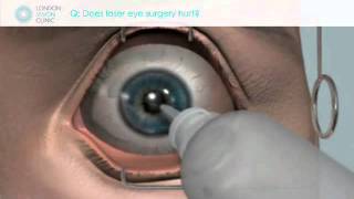 Does laser eye surgery hurt [upl. by Alih]