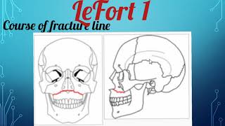 FRACTURES OF MIDDLE THIRD OF FACE PART 1 [upl. by Mctyre]