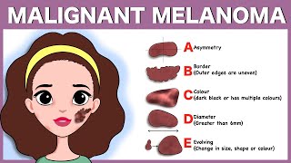 Malignant melanoma Signs Pathophysiology Types Diagnosis Treatment [upl. by Burtie]