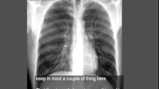 Simple Pneumothorax Explanation of Chest Xray Findings [upl. by Weidar]