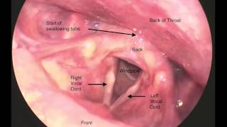 Laryngoscopy of the Vocal Folds [upl. by Arleta]