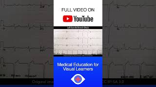 Left Bundle Branch Block LBBB ECG shorts [upl. by Larue]