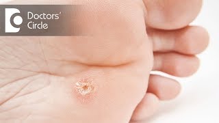 Causes amp management of Corns amp Calluses  Dr Rashmi Ravindra [upl. by Aidin]