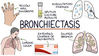 Understanding Bronchiectasis [upl. by Ezar]