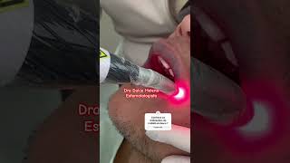 Laserterapia em doenças bucais  estomatologista laser [upl. by Euqcaj]