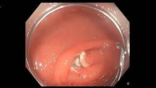 underwater EMR of colon polyp [upl. by Morell]