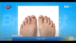 Foot rot Causes prevention and treatment  Breakfast Daily [upl. by Glenden]