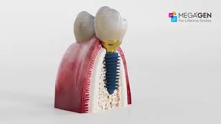 Megagen Anyridge Dental Implant [upl. by Cunningham]