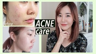 How I Got Rid of Acne Scars amp Hyperpigmentation with Korean Skincare [upl. by Hteik]