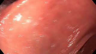 H Pylori Gastritis Endoscopy [upl. by Ennylcaj]