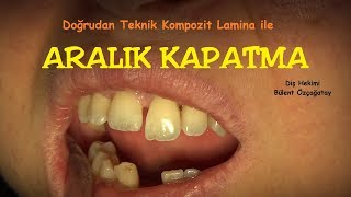 Aralık Kapatma Kompozit Laminalar 1121 [upl. by Odraboel130]