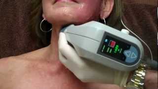 Exilis on Face amp Neck for Skin Tightening with Dr Seiler [upl. by Eslud371]