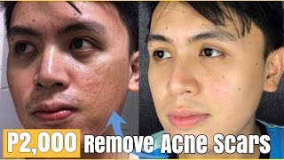 HOW TO REMOVE ACNE SCARS  P2000 FRACTIONAL LASER PAANO KUMINIS [upl. by Anirtruc]