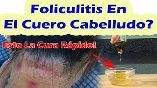 Esto Cura La Foliculitis Del Cuero Cabelludo Rápidamente  Remedios Caseros Para La Foliculitis [upl. by Nyleak]