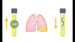 Differentiating transudative and exudative effusions transudate vs exudate [upl. by Otrebire]