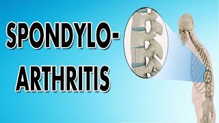 Spondyloarthropathy [upl. by Irovi]